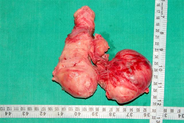 Broadligament fibroid with uterus